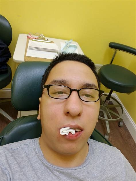 Ate pizza one day after wisdom tooth removal. . Day after wisdom teeth removal reddit